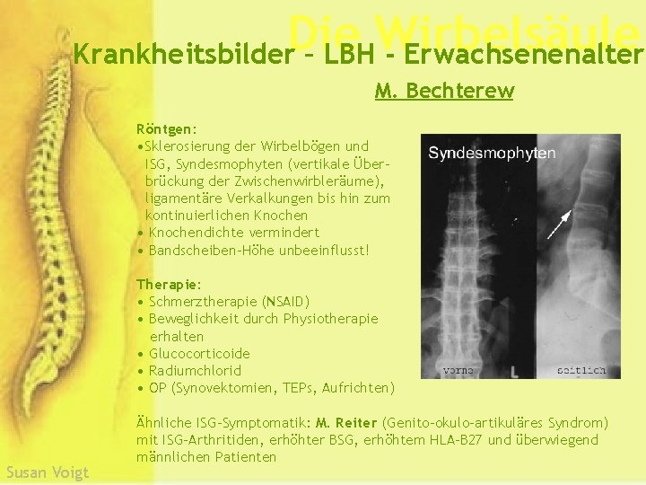 Die Wirbelsäule Krankheitsbilder – LBH - Erwachsenenalter M. Bechterew Röntgen: • Sklerosierung der Wirbelbögen