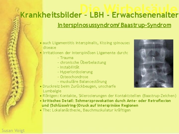 Die Wirbelsäule Krankheitsbilder – LBH - Erwachsenenalter Interspinosussyndrom/ Baastrup-Syndrom • auch Ligamentitis interspinalis, Kissing