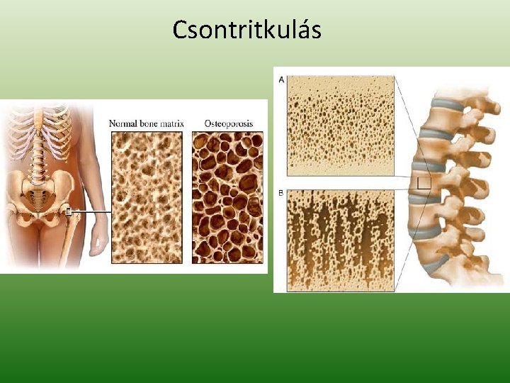 Csontritkulás 
