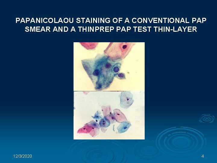 PAPANICOLAOU STAINING OF A CONVENTIONAL PAP SMEAR AND A THINPREP PAP TEST THIN-LAYER 12/3/2020