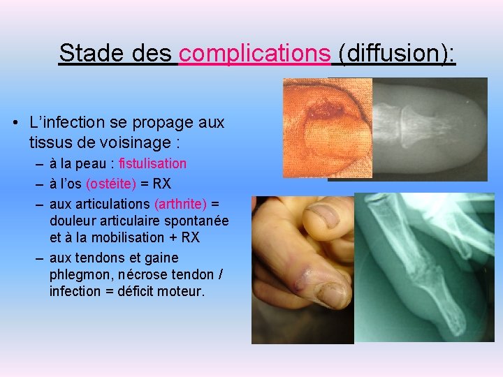 Stade des complications (diffusion): • L’infection se propage aux tissus de voisinage : –