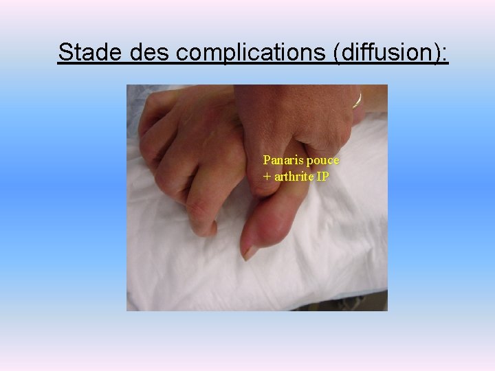 Stade des complications (diffusion): Panaris pouce + arthrite IP 