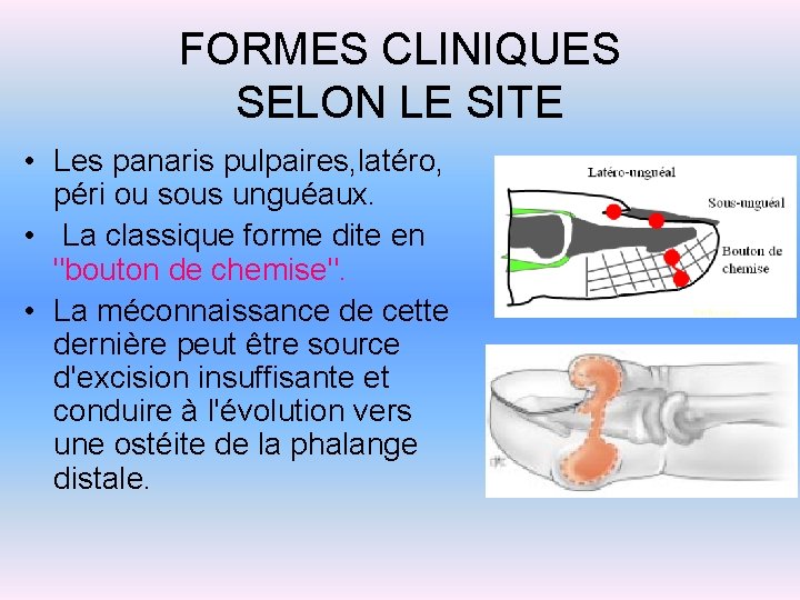 FORMES CLINIQUES SELON LE SITE • Les panaris pulpaires, latéro, péri ou sous unguéaux.