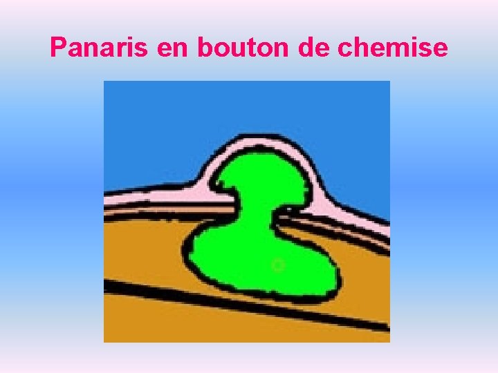 Panaris en bouton de chemise 