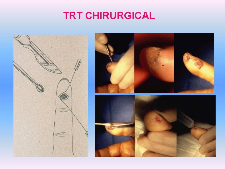 TRT CHIRURGICAL 