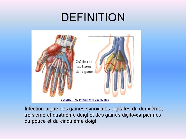 DEFINITION Infection aiguë des gaines synoviales digitales du deuxième, troisième et quatrième doigt et