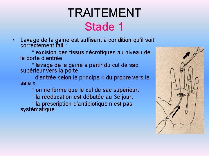 TRAITEMENT Stade 1 • Lavage de la gaine est suffisant à condition qu’il soit