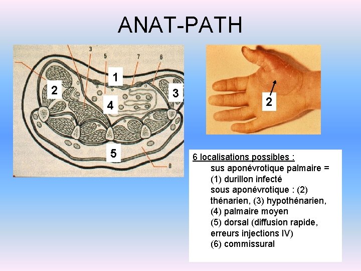 ANAT-PATH 2 1 4 5 3 2 6 localisations possibles : sus aponévrotique palmaire