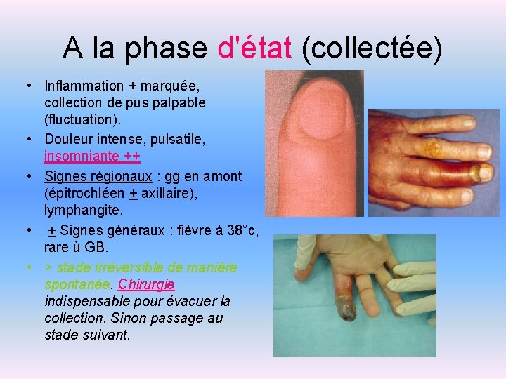 A la phase d'état (collectée) • Inflammation + marquée, collection de pus palpable (fluctuation).