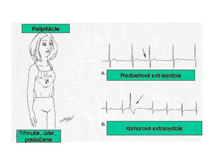 Palpitácie Predsieňová extrasystola Trhnutie, úder, poskočenie Komorová extrasystola 