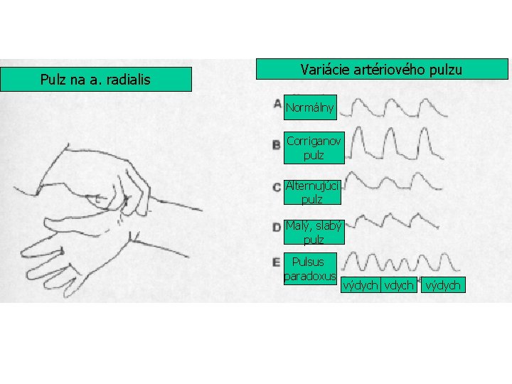 Pulz na a. radialis Variácie artériového pulzu Normálny Corriganov pulz Alternujúci pulz Malý, slabý