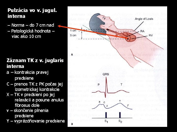 Pulzácia vo v. jugul. interna – Norma – do 7 cm nad – Patologická