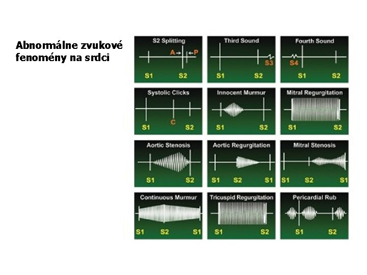 Abnormálne zvukové fenomény na srdci 