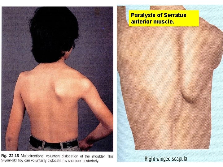 Paralysis of Serratus anterior muscle. 