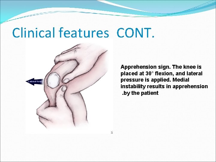 Clinical features CONT. Apprehension sign. The knee is placed at 30° flexion, and lateral