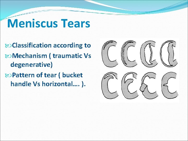 Meniscus Tears Classification according to Mechanism ( traumatic Vs degenerative) Pattern of tear (