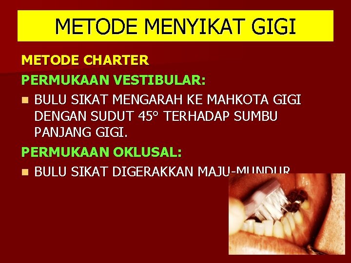METODE MENYIKAT GIGI METODE CHARTER PERMUKAAN VESTIBULAR: n BULU SIKAT MENGARAH KE MAHKOTA GIGI METODE MENYIKAT GIGI METODE CHARTER PERMUKAAN VESTIBULAR: n BULU SIKAT MENGARAH KE MAHKOTA GIGI