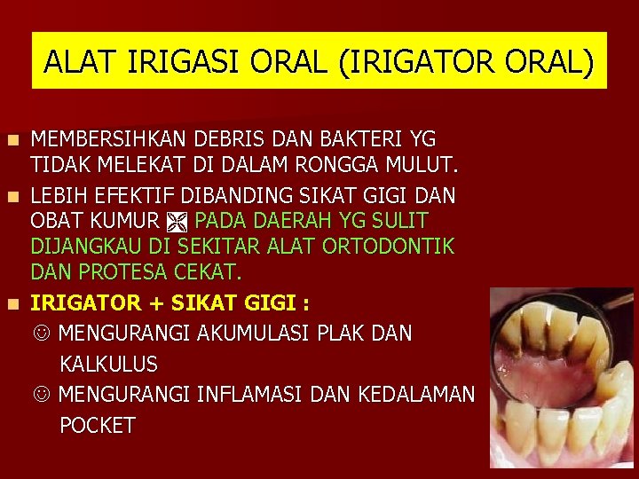 ALAT IRIGASI ORAL (IRIGATOR ORAL) MEMBERSIHKAN DEBRIS DAN BAKTERI YG TIDAK MELEKAT DI DALAM