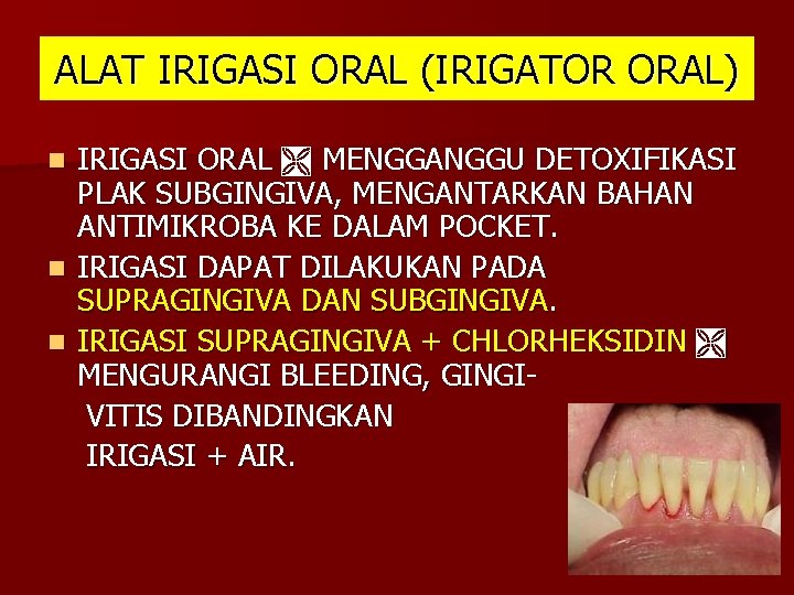 ALAT IRIGASI ORAL (IRIGATOR ORAL) IRIGASI ORAL MENGGANGGU DETOXIFIKASI PLAK SUBGINGIVA, MENGANTARKAN BAHAN ANTIMIKROBA ALAT IRIGASI ORAL (IRIGATOR ORAL) IRIGASI ORAL MENGGANGGU DETOXIFIKASI PLAK SUBGINGIVA, MENGANTARKAN BAHAN ANTIMIKROBA