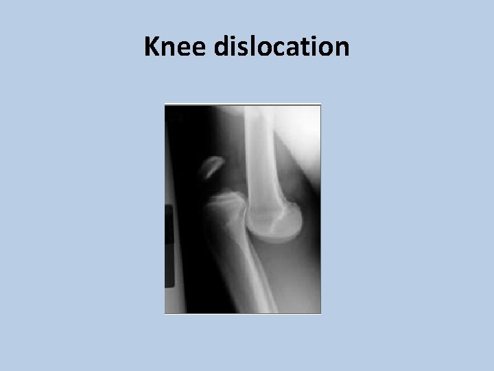 Knee dislocation 