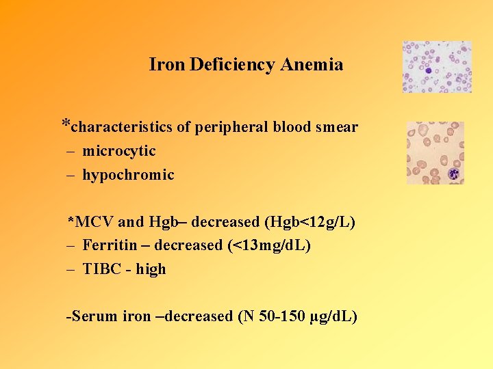 Iron Deficiency Anemia *characteristics of peripheral blood smear – microcytic – hypochromic *MCV and