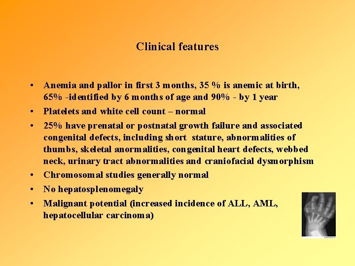 Clinical features • Anemia and pallor in first 3 months, 35 % is anemic