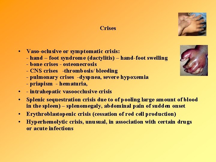 Crises • Vaso-oclusive or symptomatic crisis: - hand – foot syndrome (dactylitis) – hand-foot