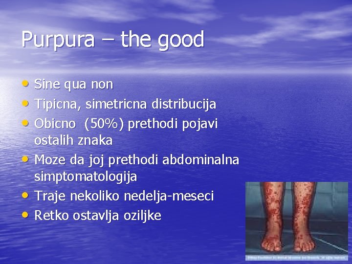 Purpura – the good • Sine qua non • Tipicna, simetricna distribucija • Obicno