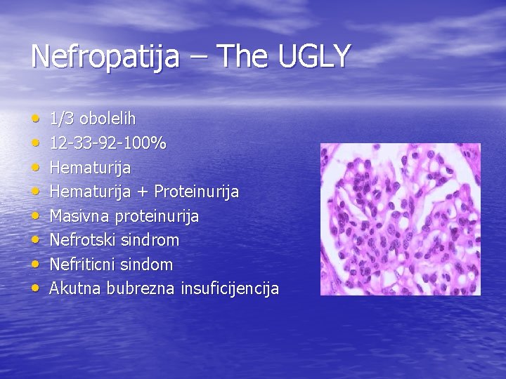 Nefropatija – The UGLY • • 1/3 obolelih 12 -33 -92 -100% Hematurija +