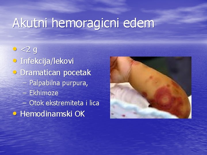 Akutni hemoragicni edem • <2 g • Infekcija/lekovi • Dramatican pocetak – Palpabilna purpura,