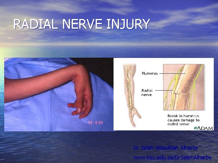 RADIAL NERVE INJURY Dr Saleh Wasl. Allah Alharby www. ksu. edu. sa/Dr. Saleh. Alharby RADIAL NERVE INJURY Dr Saleh Wasl. Allah Alharby www. ksu. edu. sa/Dr. Saleh. Alharby