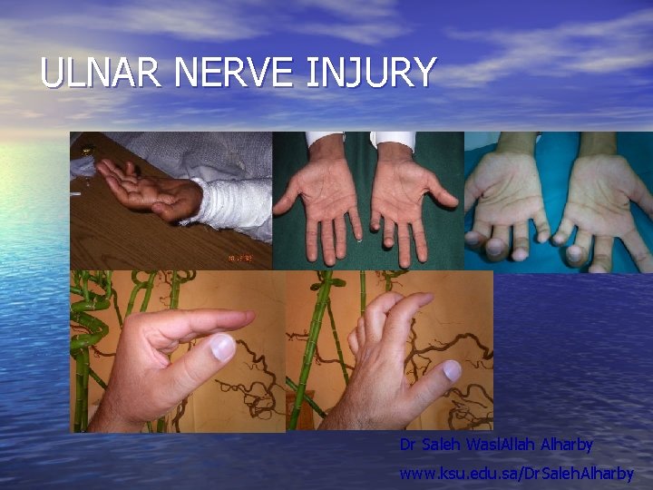 ULNAR NERVE INJURY Dr Saleh Wasl. Allah Alharby www. ksu. edu. sa/Dr. Saleh. Alharby ULNAR NERVE INJURY Dr Saleh Wasl. Allah Alharby www. ksu. edu. sa/Dr. Saleh. Alharby