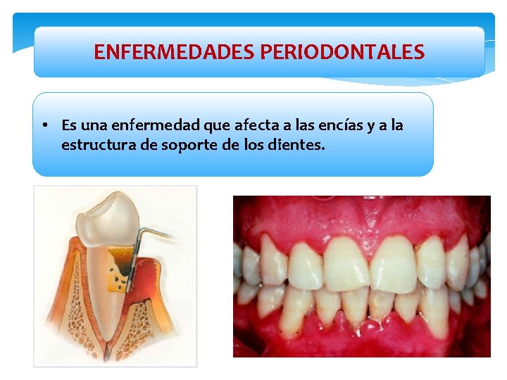 ENFERMEDADES PERIODONTALES • Es una enfermedad que afecta a las encías y a la