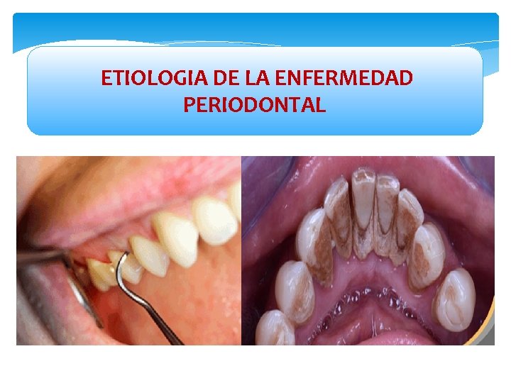  ETIOLOGIA DE LA ENFERMEDAD PERIODONTAL 