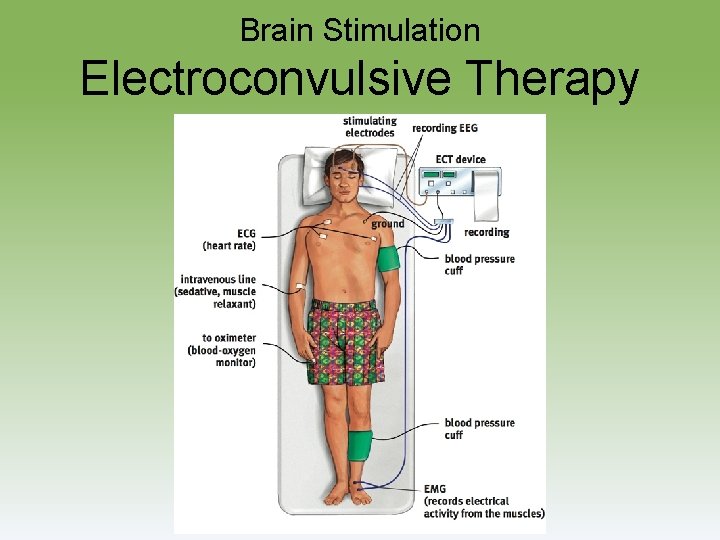 Brain Stimulation Electroconvulsive Therapy 