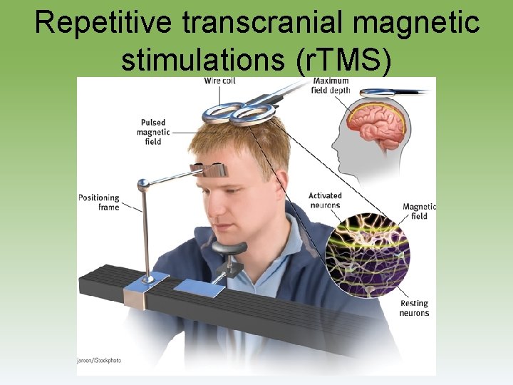 Repetitive transcranial magnetic stimulations (r. TMS) 