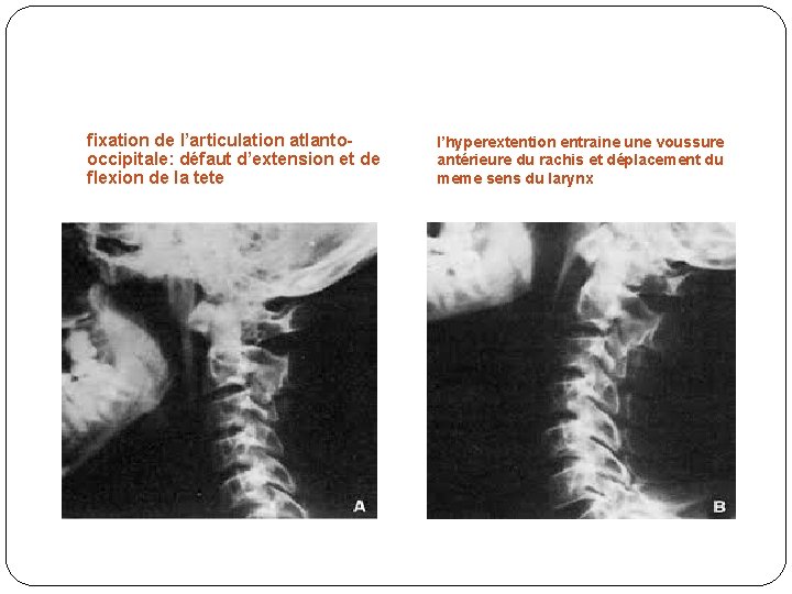 fixation de l’articulation atlantooccipitale: défaut d’extension et de flexion de la tete l’hyperextention entraine