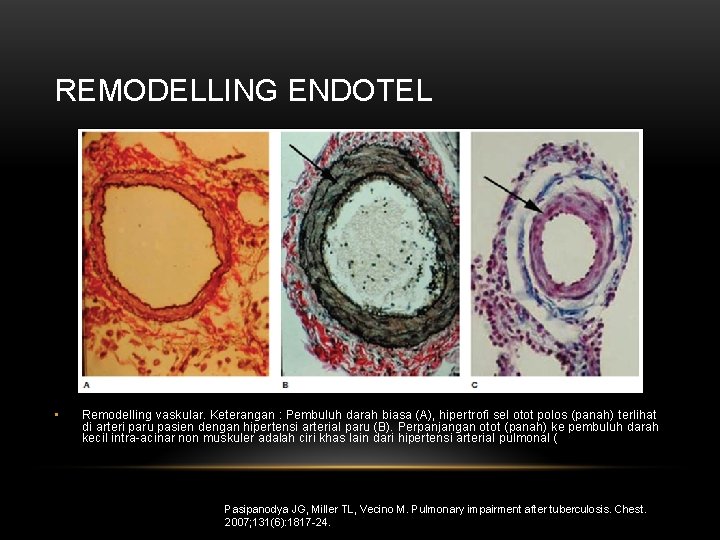 REMODELLING ENDOTEL • Remodelling vaskular. Keterangan : Pembuluh darah biasa (A), hipertrofi sel otot