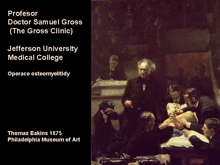 Profesor Doctor Samuel Gross (The Gross Clinic) Jefferson University Medical College Operace osteomyelitidy Thomas