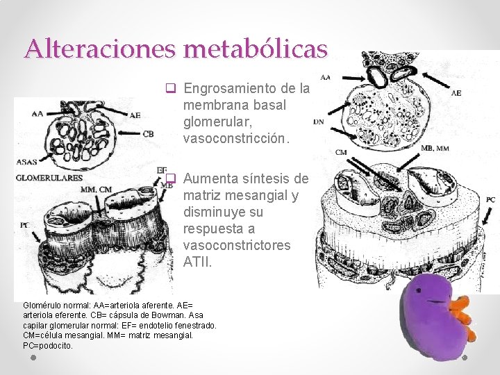 Alteraciones metabólicas q Engrosamiento de la membrana basal glomerular, vasoconstricción. q Aumenta síntesis de
