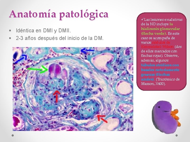 Anatomía patológica § Idéntica en DMI y DMII. § 2 -3 años después del
