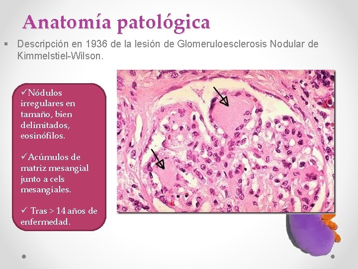Anatomía patológica § Descripción en 1936 de la lesión de Glomeruloesclerosis Nodular de Kimmelstiel-Wilson.