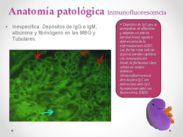 Anatomía patológica Inmunofluorescencia § Inespecífica. Depósitos de Ig. G e Ig. M, albúmina y