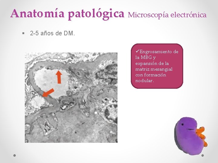 Anatomía patológica Microscopía electrónica § 2 -5 años de DM. üEngrosamiento de la MBG