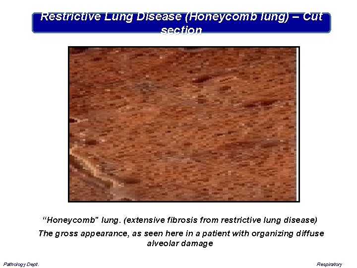 Restrictive Lung Disease (Honeycomb lung) – Cut section “Honeycomb" lung. (extensive fibrosis from restrictive