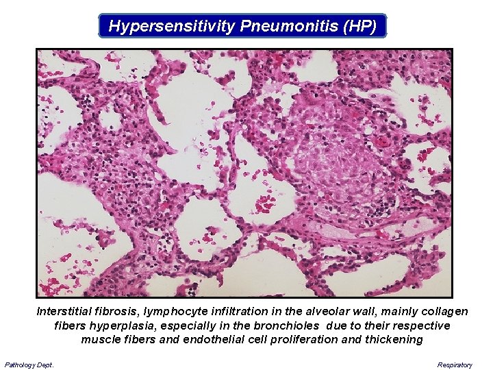 Hypersensitivity Pneumonitis (HP) Interstitial fibrosis, lymphocyte infiltration in the alveolar wall, mainly collagen fibers