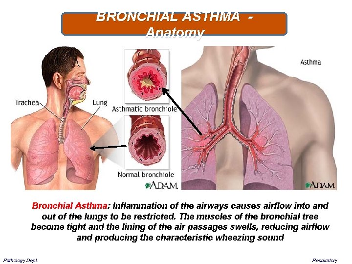 BRONCHIAL ASTHMA - Anatomy Bronchial Asthma: Inflammation of the airways causes airflow into and