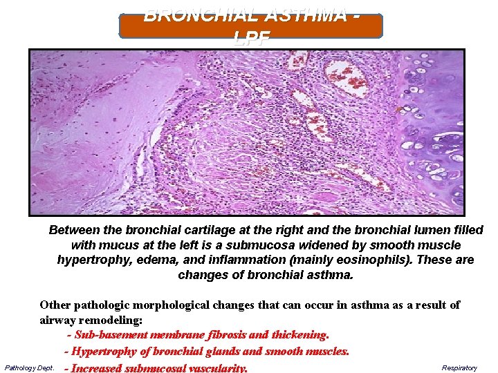 BRONCHIAL ASTHMA - LPF Between the bronchial cartilage at the right and the bronchial