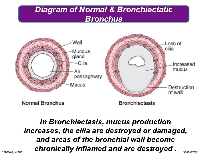 Diagram of Normal & Bronchiectatic Bronchus Pathology Dept. In Bronchiectasis, mucus production increases, the
