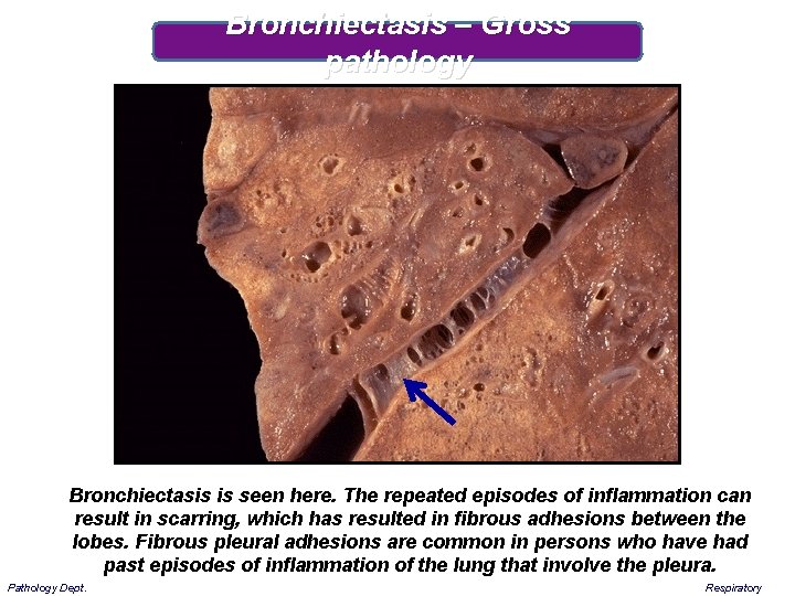 Bronchiectasis – Gross pathology Bronchiectasis is seen here. The repeated episodes of inflammation can